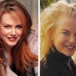 Nicole Kidman prima e dopo il Botox