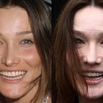 L'orribile viso di Carla Bruni dopo il Botox